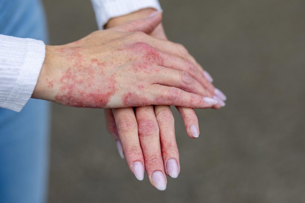 3. Simptomele eczemei (pete rosiatice, piele uscata si crapata, maini afectate de eczema)