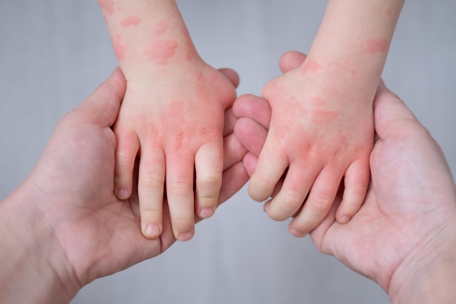 4. Eczema la copii (pete pe maini, mancarimi, adult care inspecteaza mainile unui copil)